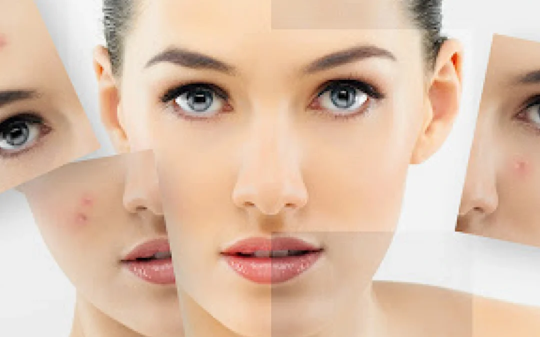 What is Cosmetic Acupuncture?