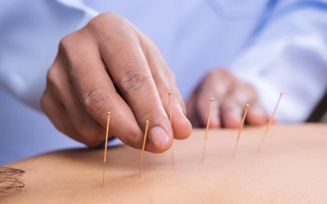 Using Acupuncture For Allergies