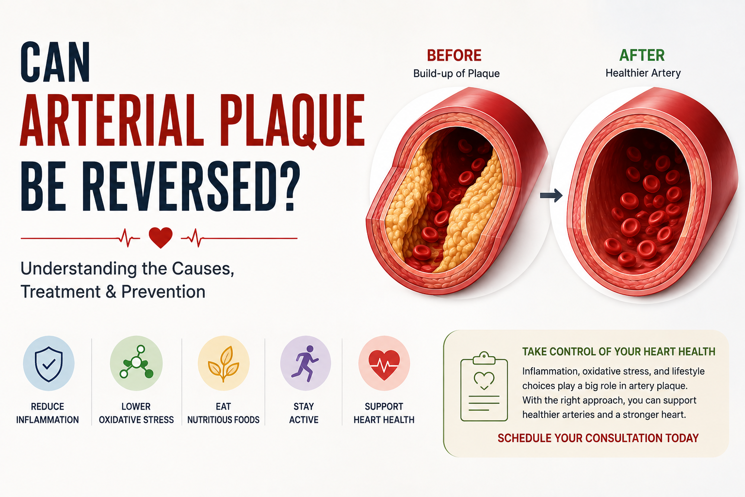 Arterial Plaque Really Be Reversed